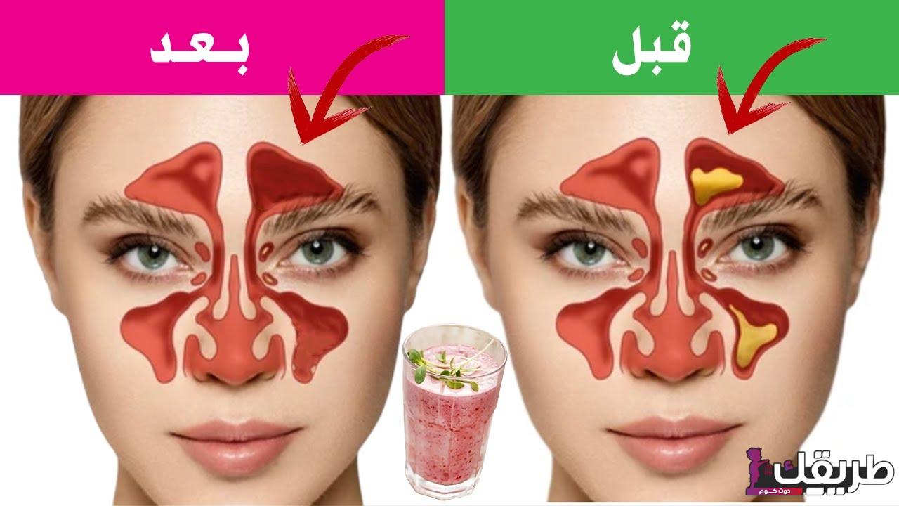 تجربتي الشخصية في علاج الجيوب الأنفية بطرق طبيعية 7 maxresdefault 9